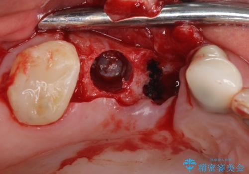奥歯で噛みたい 破折した歯のインプラント治療の治療中