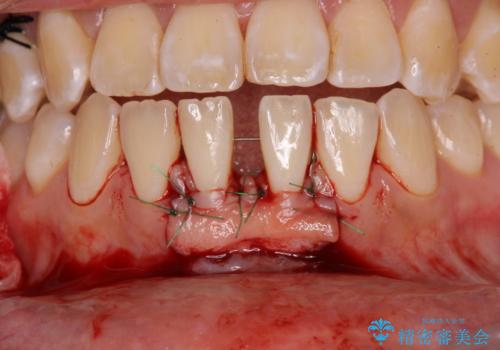 矯正の後戻りによるすきっ歯と歯肉退縮 根面被覆と部分矯正の治療中