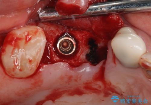 奥歯で噛みたい 破折した歯のインプラント治療の治療後