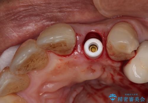 破折した前歯のインプラント 1DAYインプラントで短期間治療の治療前