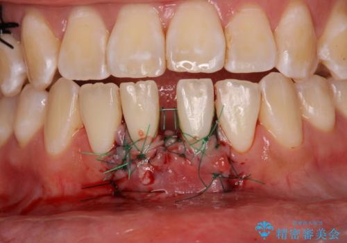 矯正の後戻りによるすきっ歯と歯肉退縮 根面被覆と部分矯正の治療後