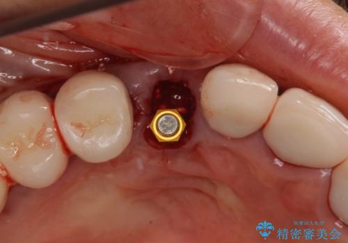 ニューヨークから1泊で通院 1DAYインプラントの治療後