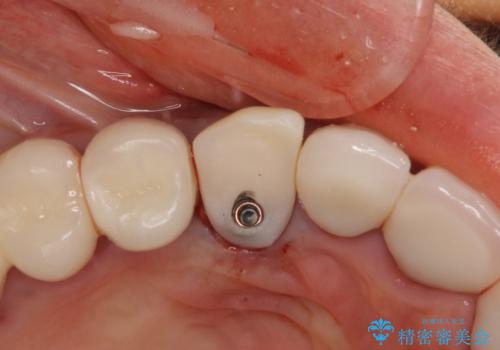 ニューヨークから1泊で通院 1DAYインプラントの治療中