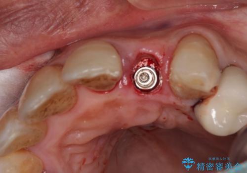 破折した前歯のインプラント 1DAYインプラントで短期間治療の治療中