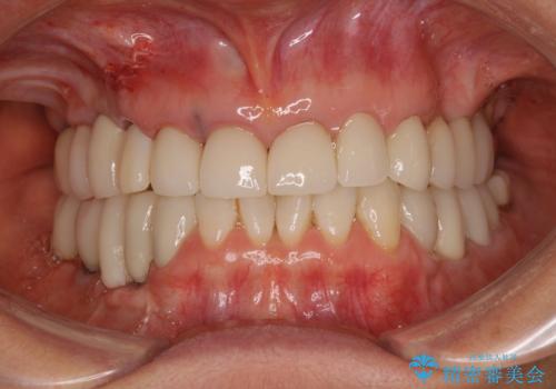 ニューヨークから1泊で通院 1DAYインプラントの治療中