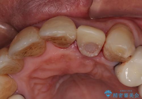 破折した前歯のインプラント 1DAYインプラントで短期間治療の治療中