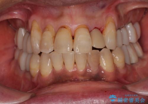 破折した前歯のインプラント 1DAYインプラントで短期間治療の治療中
