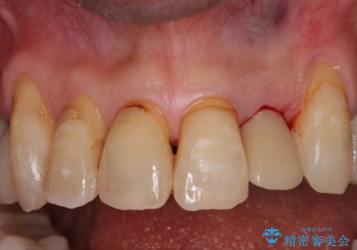 破折した前歯のインプラント 1DAYインプラントで短期間治療の治療中