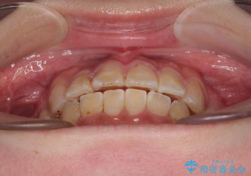 転位歯や埋伏歯などの難易度の高い抜歯矯正治療の治療後