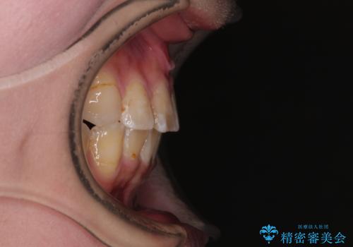 転位歯や埋伏歯などの難易度の高い抜歯矯正治療の治療後