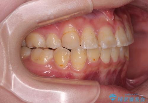 転位歯や埋伏歯などの難易度の高い抜歯矯正治療の治療後