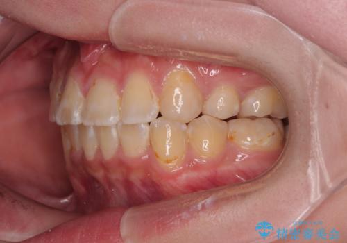 転位歯や埋伏歯などの難易度の高い抜歯矯正治療の治療後