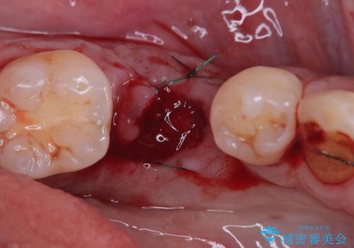 20年前にいれたインプラント|インプラント周囲炎|古いインプラントを除去しインプラント再埋入|痛く無いインプラント治療の治療前