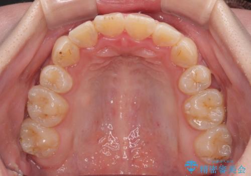 転位歯や埋伏歯などの難易度の高い抜歯矯正治療の治療後