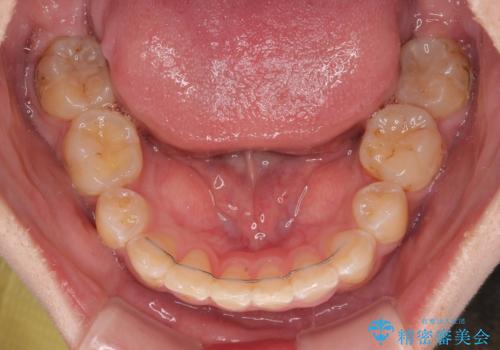 転位歯や埋伏歯などの難易度の高い抜歯矯正治療の治療後