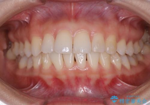 【部分矯正】必要最低限の移動でガタつきを改善するの治療中