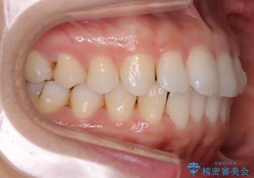 【部分矯正】必要最低限の移動でガタつきを改善するの治療中