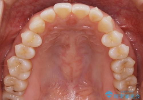 【部分矯正】必要最低限の移動でガタつきを改善するの治療中