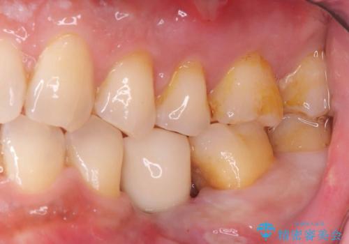 20年前にいれたインプラント|インプラント周囲炎|古いインプラントを除去しインプラント再埋入|痛く無いインプラント治療の治療後