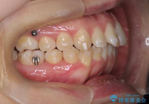 前歯の出っ張りをマウスピースで改善の治療中