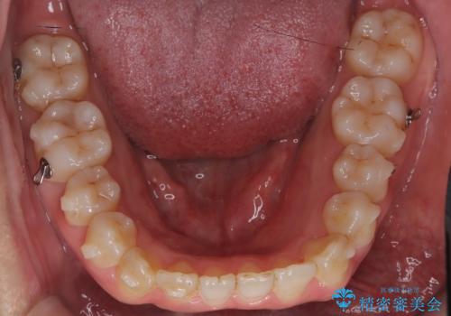 前歯の出っ張りをマウスピースで改善の治療中