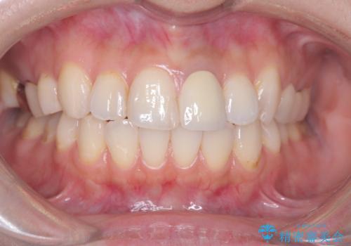 前歯の色が気になる!|オールセラミッククラウンの治療後