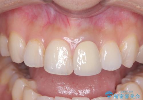 前歯の色が気になる!|オールセラミッククラウンの治療後