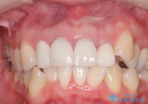 被せ物治療の前のホワイトニングの症例 治療前