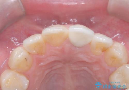 前歯の色が気になる!|オールセラミッククラウンの治療後