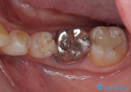 割れてしまった奥歯 インプラント治療の治療前