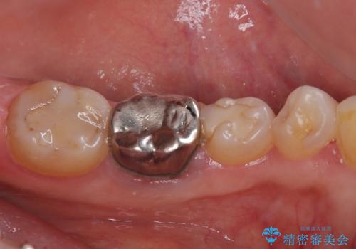 割れてしまった奥歯 インプラント治療の治療前