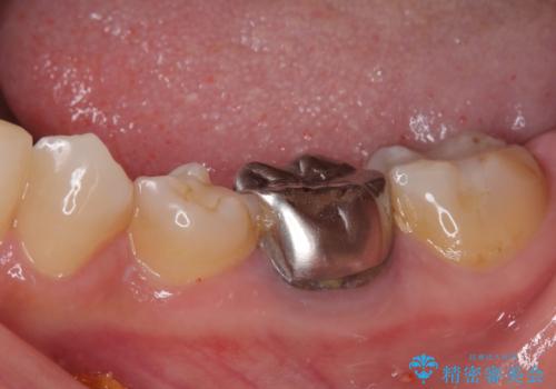 割れてしまった奥歯 インプラント治療の治療前