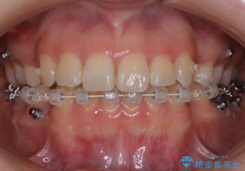 【抜歯】ハーフリンガル矯正で韓国美人な横顔へ!の治療中