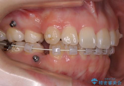 【抜歯】ハーフリンガル矯正で韓国美人な横顔へ!の治療中