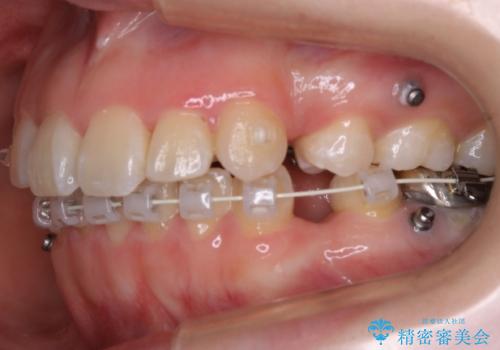 【抜歯】ハーフリンガル矯正で韓国美人な横顔へ!の治療中