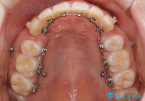 【抜歯】ハーフリンガル矯正で韓国美人な横顔へ!の治療中