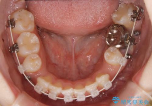 【抜歯】ハーフリンガル矯正で韓国美人な横顔へ!の治療中