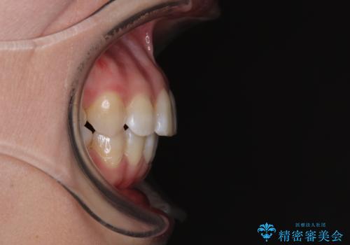 インビザライン・モデレートを用いて気になる後戻りを矯正治療の治療後