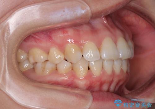 インビザライン・モデレートを用いて気になる後戻りを矯正治療の治療後