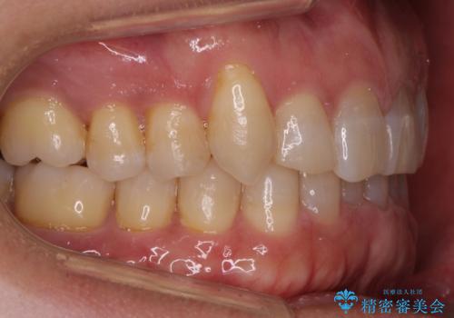 八重歯と下の歯のがたつき マウスピースでの治療後