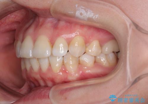 インビザライン・モデレートを用いて気になる後戻りを矯正治療の治療後