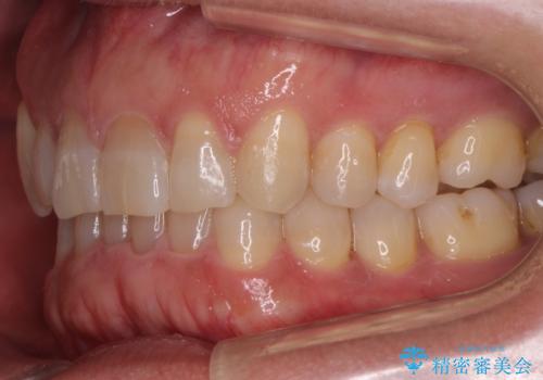 八重歯と下の歯のがたつき マウスピースでの治療後