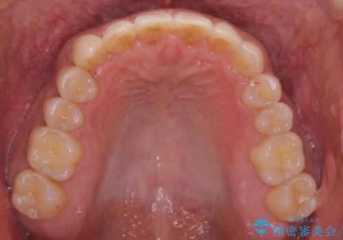 八重歯と下の歯のがたつき マウスピースでの治療後
