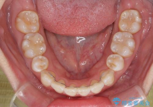 インビザライン・モデレートを用いて気になる後戻りを矯正治療の治療後