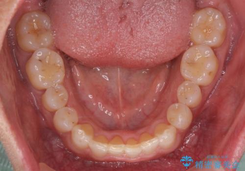 八重歯と下の歯のがたつき マウスピースでの治療後
