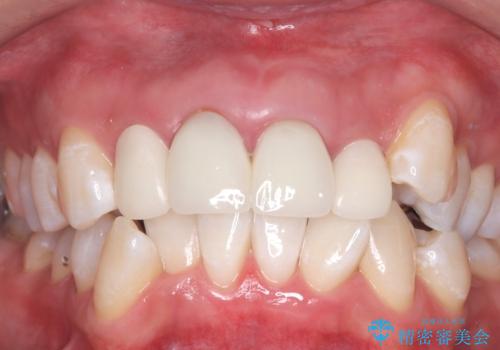 被せ物治療の前のホワイトニングの症例 治療後