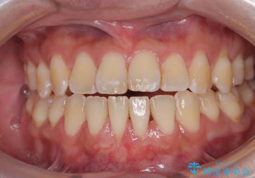 矯正の後戻りによるすきっ歯と歯肉退縮 根面被覆と部分矯正の治療後