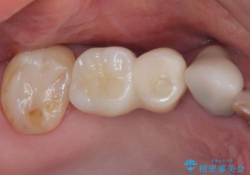 奥歯で噛みたい 破折した歯のインプラント治療の症例 治療後