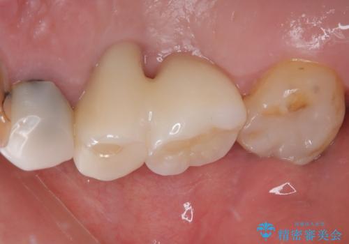 奥歯で噛みたい 破折した歯のインプラント治療の治療後