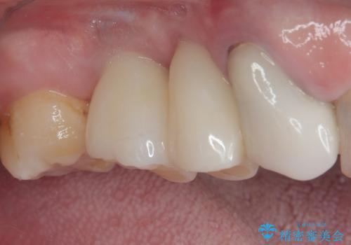 奥歯で噛みたい 破折した歯のインプラント治療の治療後